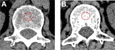 Bone mineral density as an individual prognostic biomarker in NSCLC patients treated with immune checkpoint inhibitors